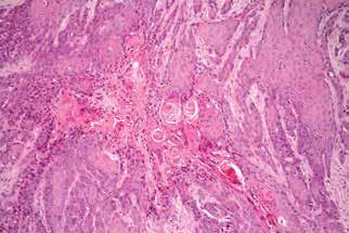 Rohovějící dlaždicobuněčný karcinom sestává z větších polygonálních buněk s eozinofilní cytoplazmou. U lépe diferencovaných nádorů je přítomno rohovění. (HE, původní zvětšení 400x) Obr. 7.