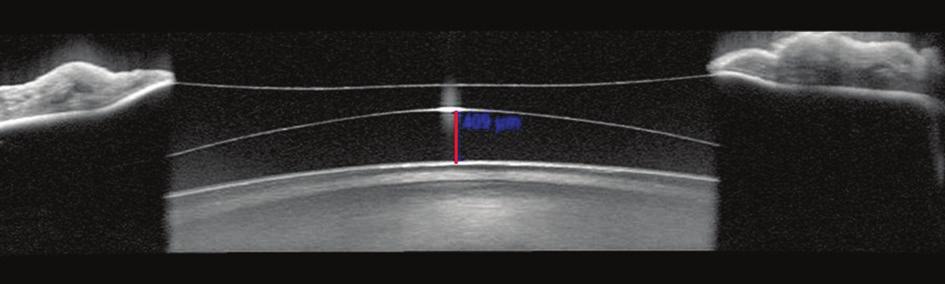Obr. 1 Měření vaultu pomocí OCT předního segmentu continuity correction, p = 0,00845). Ke vzniku pigmentového glaukomu v našem souboru nedošlo.