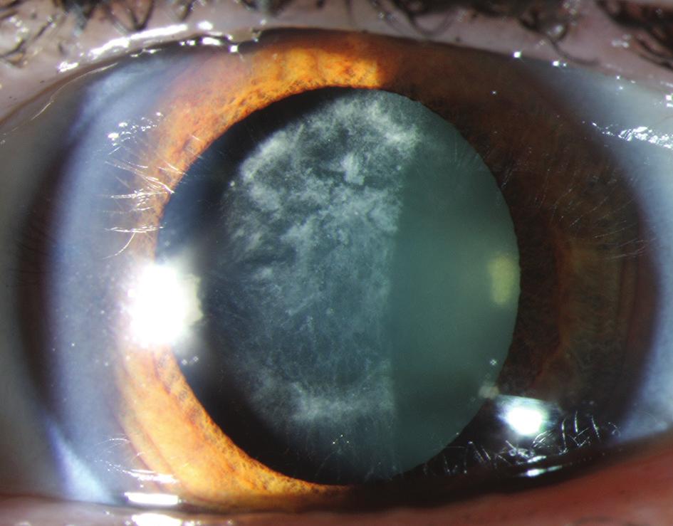 efektu na vizus u 1 myopického oka (2,5 %). Incipientní předhovkovou mikroincizí vel. 2,8 mm rozšířenou na 3 3,2 mm s dvěma pomocnými paracentézami vel. 0,8 1,0 mm.