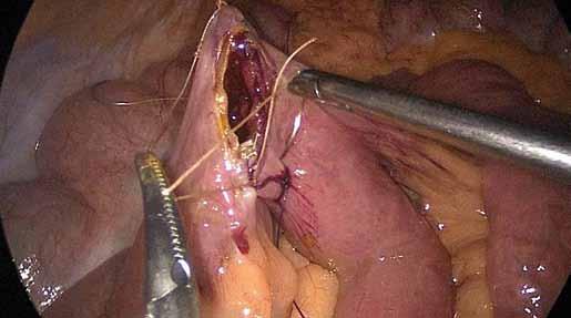 Hereditárny Parciální jejunální angioedém diverze ako technické príčina bolestí aspekty brucha a počáteční zkušenosti Obr. 2. Šití jejun-oileální anastomózy. Fig. 2. Jejuno-ileal anastomosis suture.