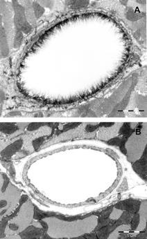 Glycocalyx damage edema and loss of capillaries 1) decrease in capillary diameter by perivascular edema 2) Decrease in number