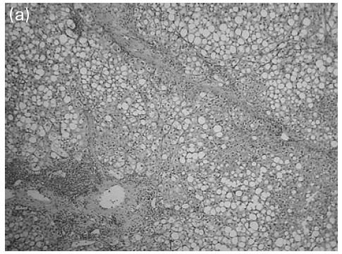 Vývoj PNALD po izolované Tx střeva před transplantací (a) Marked micro- and macrovesicular lipid vacuoles