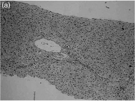 Vývoj PNALD po izolované Tx střeva 7m po ISBTx Liver histology obtained by percutaneous needle biopsy at