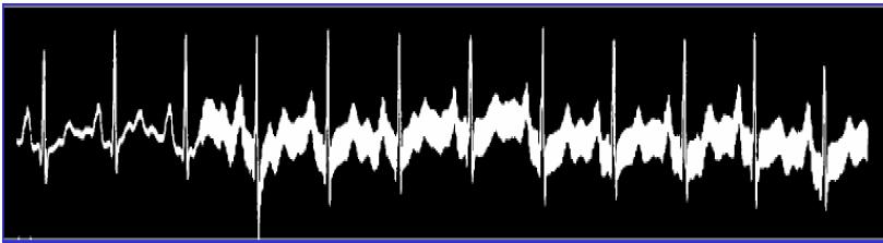 Rušení signálu EKG ÚZKOPÁSMOVÉ RUŠENÍ kolísání (drift) základní izoelektrické linie pomalé elektrochemické děje na