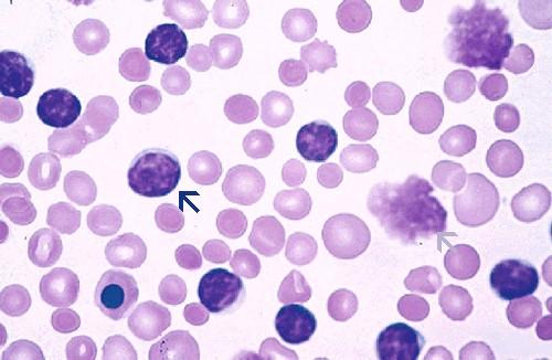 2.1.4.1 Krevní obraz Pro diagnózu CLL je vyžadováná přítomnost nejméně 5x10 9 B lymfocytů/l (5000/µl) v periferní krvi. Klonalita B lymfocytů musí být ověřena průtokovou cytometrií.