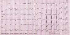 Tabulka 1 Rozsah postižení koronárního řečiště podle četnosti (podrobně k obrázku 3) Obrázek 2 Typický obraz EKG u pacienta s těžkou stenózou kmene levé věnčité tepny a ischemií myokardu Distální