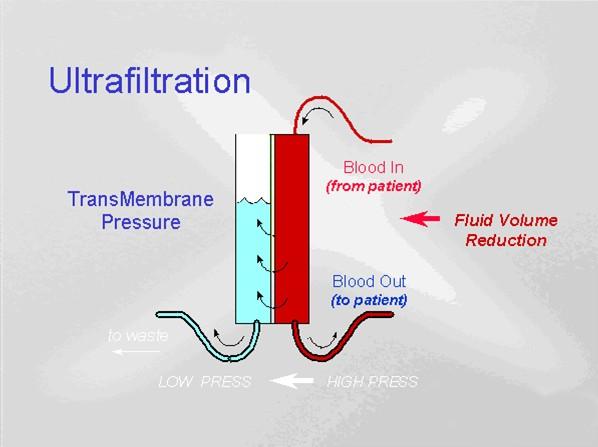 Ultrafiltrace Požadovaná hodinová diuréza V ml/h Separace plasmatické vody a v ní obsažených