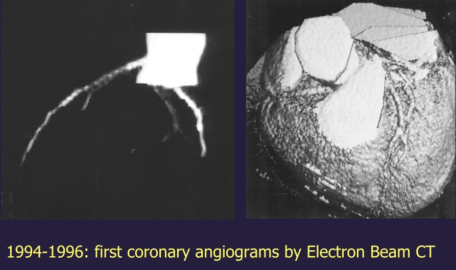 První zobrazení koronárního angiogramu
