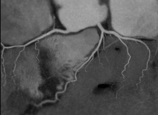 Improved visualization of coronary segments