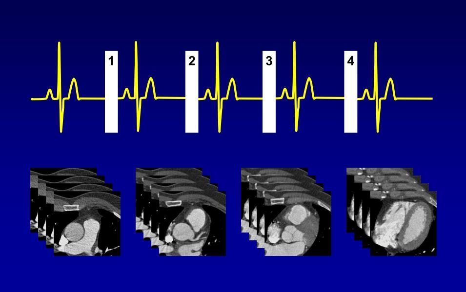 Technika CT zásadní synchronizace dat s EKG - retrospektivní,
