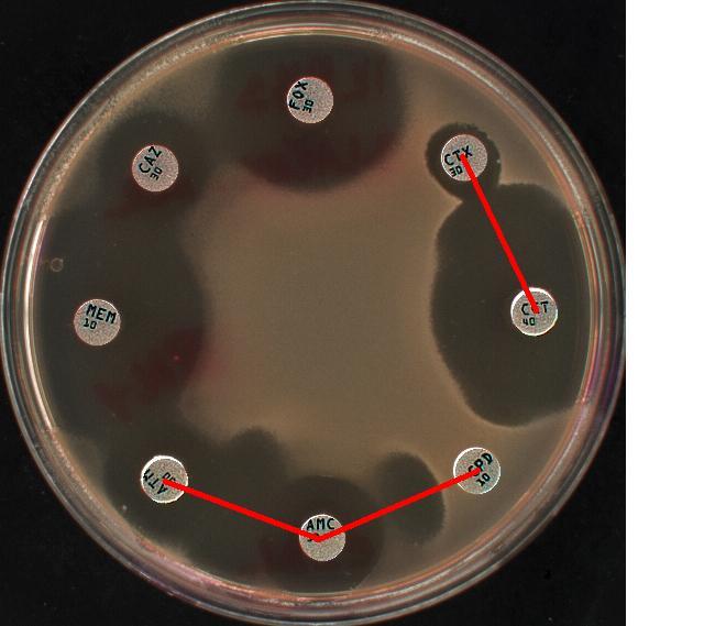 Klebsiella pneumoniae s produkcí ESBL, námi používaná sestava k detekci ESBL s použitím double disc synergy test + signifikantního rozdílu průměrů