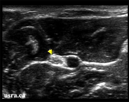 midhumeral, loket Ulnar n. midhumeral, předloktí Median n.