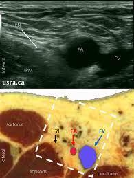 Lumbar plexus blocks - Psoas compartment