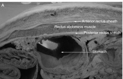 Rectus sheath blok Přední větve nervů T6-L1 inervace břišní