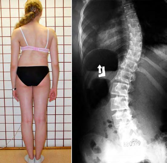 S type scoliosis standing Fig. 5a, 5b: Patient 15 years old. S type scoliosis, I epg.