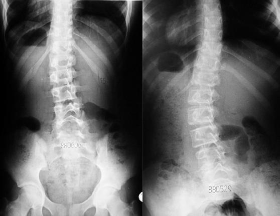 C type scoliosis 5a 5b gait standing C 6a Fig. 6a, 6b: Patient 13 years old (fig. 6a) C type II/A epg scoliosis and 16 years old (fig.