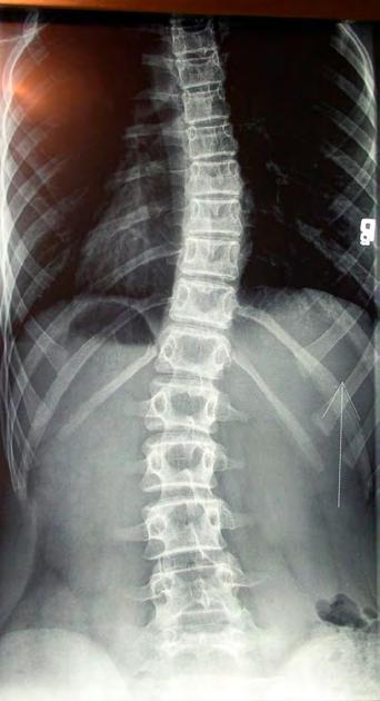 The spine is stiff, no curves occur, or they are minimal. (Fig. 5a, 5b, 6a, 6b, 7a, 7b, 8a, 8b). Every scoliosis type becomes a degenerative scoliosis in older people. (Fig. 9a, 9b, 9c).