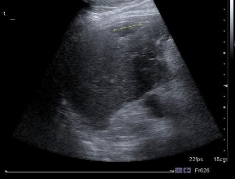 Vyšetření jater pomocí CT je nutné provést minimálně ve 2 fázích, a to ve fázi arteriální a ve fázi portální (Skalický, 2008). CT při průkazu jaterních lézí dosahuje senzitivitu až 90 %.