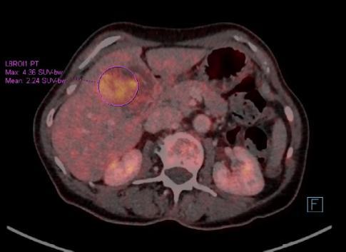 senzitivitu PET/CT 90 %, kdy nativní ultrasonografie měla senzitivitu 55 %, CT 72 % a MR 76 % (Ehrmann, 2014).