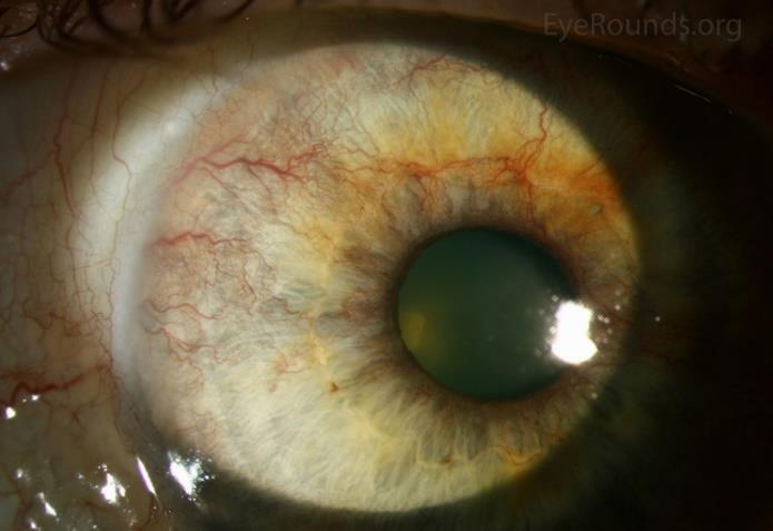 Obrázek 5 Neovaskularizace duhovky 2.8 Čočka Také oční čočka může být zatížena možnými komplikacemi. Ty nastávají, pokud není DM kompenzovaný nebo pokud hyperglykémie přetrvává delší dobu.