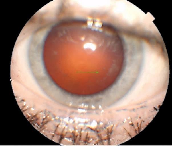 2.8.2 Katarakta Katarakta (obrázek 6), šedý zákal, se projevuje zakalením čočky a její výskyt patří mezi velmi časté oční komplikace diabetu.
