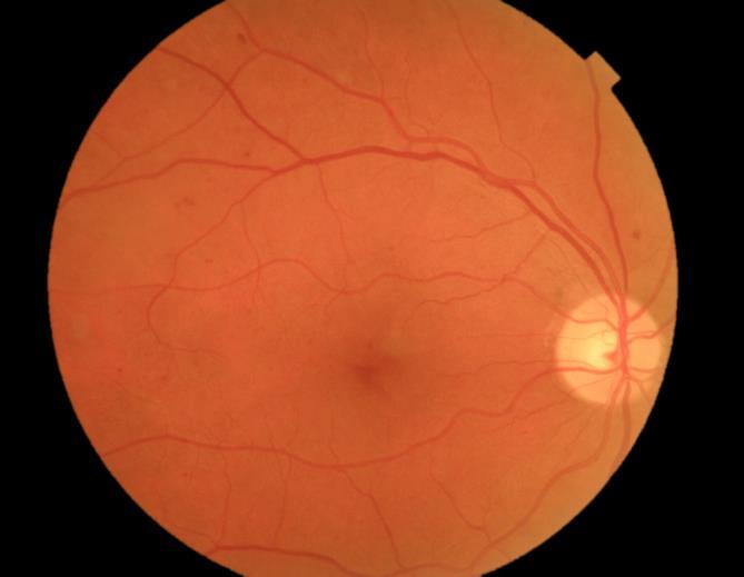Obrázek 8 Neproliferativní diabetická retinopatie Obrázek 9 Proliferativní diabetická retinopatie 2.10