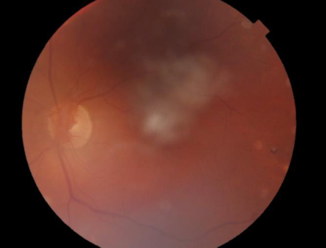 pacienta o možných komplikacích a pravidelnosti preventivních prohlídek u oftalmologa.