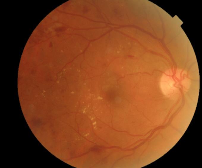 Léčba spočívá v kombinaci aplikace medikamentů do sklivce ve sterilním prostředí, laserové fotokoagulaci či chirurgické léčbě. Na prvním místě se uplatňuje intravitreální aplikace anti-vegf preparátů.