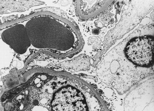 Glomerulární poruchy Rifampicin Sulfonamidy Keisuke et al.