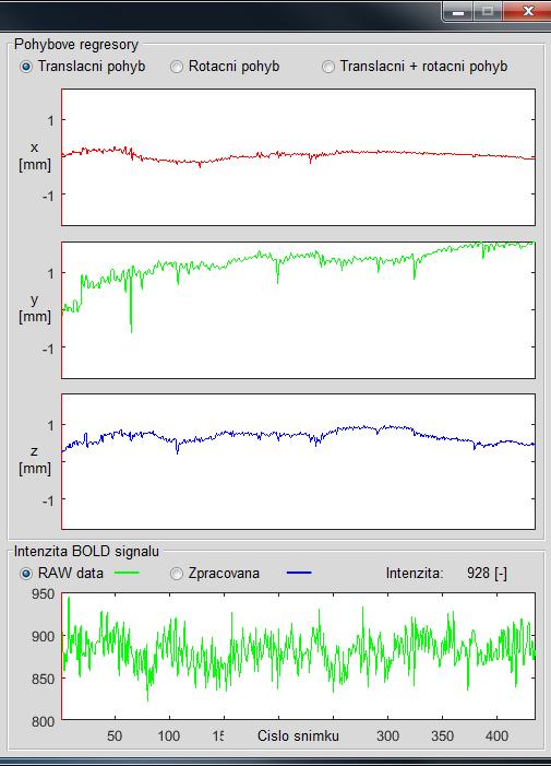 Obrázek 29: Časový vývoj pohybových regresorů a BOLD signálu, 2 módy zobrazení Při výběru zobrazení funkčních