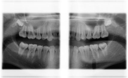 Bitewing program Tento program vytváří Bite-Wing snímky premolárů a molárů včetně části maxily, mandibule a rami. Jsou viditelné spodní část maxillary sinus, mandibulární kanál a mental foramen.