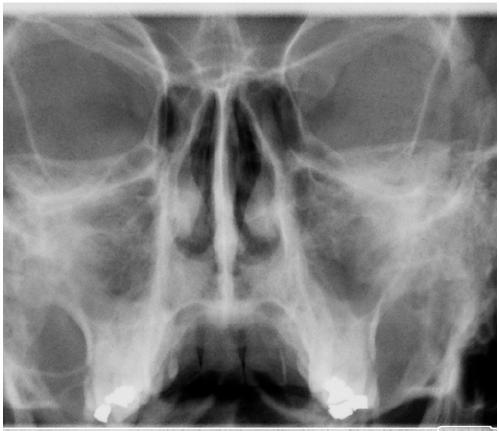 5.3.2 Specielní Sinus programy Sinus PA nerotační program Nerotační expozice PA