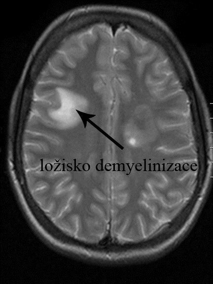 pátráme po přítomnosti protilátek, což jsou působky imunitního systému, které jsou zodpovědné za rozpoznání a následné zničení myelinového obalu axonů.