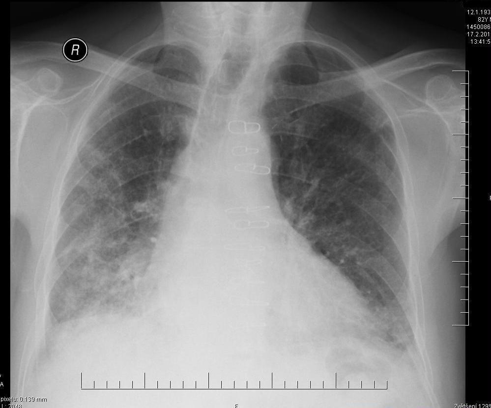 I velmi rozdílné choroby mívají podobný obraz na skiagramu hrudníku