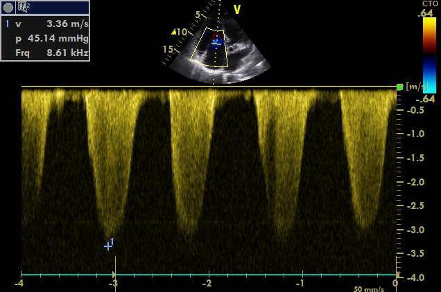 8 = 25 ml CO = SV x srd. frekv.