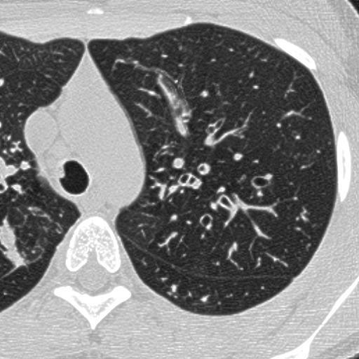 Míra postižení Hodnocena u bronchiektázií a zesílení stěny bronchu Skóre 0 (norm. nález) 3 (max.