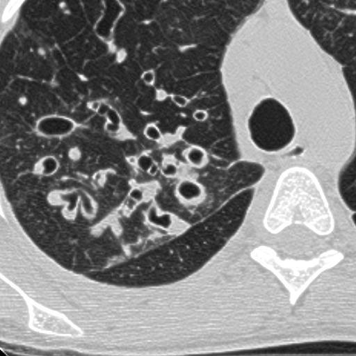 / (AOD) > 33% BWT/AOD ratio CT-score