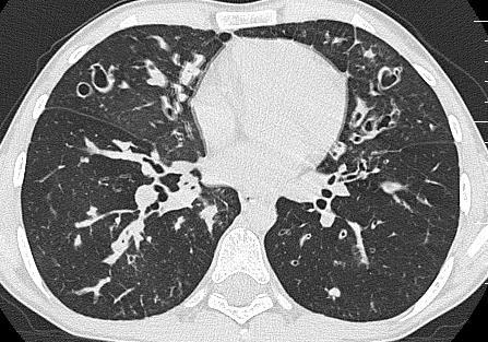 Vyplnění bronchů hlenem (mucous plugging) větší