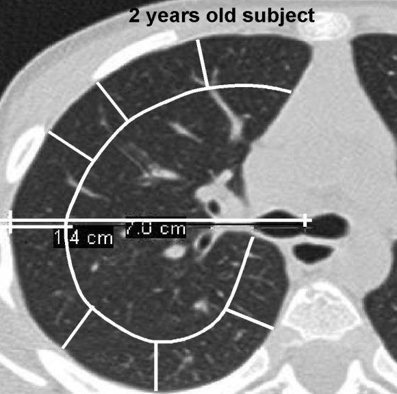 Distribuce centrální x periferní Hodnocena u bronchiektázií, zesílení