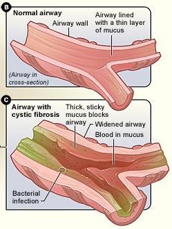 Patogeneze postižení plic Cystická fibróza Obstrukce submukózních žláz Hyperplázie a hypersekrece žláz bronchů Vyplnění malých bronchů vazkým hlenem Porušená