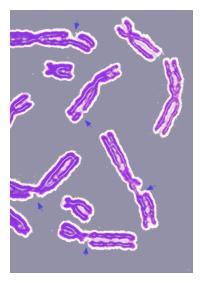 Poškození DNA Velice závažný stav Poškození DNA se odrazí v syntéze