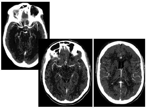 Dárce orgánu dárce se smrtí mozku a bijícím srdcem DBD (donation after brain death) ledviny, játra, pankreas (+ ostrůvky),