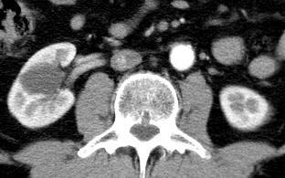 (jen ledviny) Renální cévy Časné sycení nádoru Nefrografická fáze