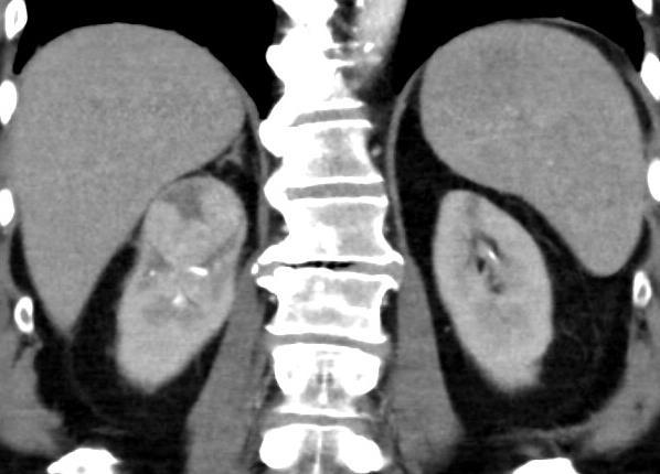 CT triple bolus protokol Kortikomedulární + nefrografická + vylučovací f.