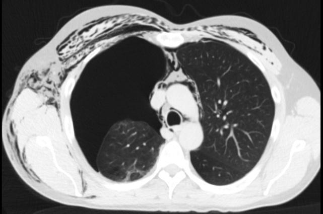 Komplikace hrudní drenáže: Důsledek invaze drénu - krvácení do hrudní stěny - krvácení do pleurálního prostoru (iatrogenní hemothorax) - zanesení infekce