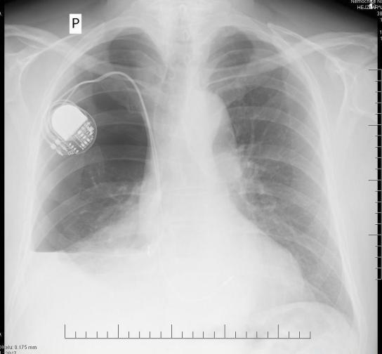 Léčba pneumothoraxu (PNO) Léčebné možnosti: sledování, event.