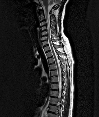 Obr. 1. MR míchy, intramedulárně přítomné rozsáhlé hypersignální ložisko vřetenovitého tvaru sahající od úrovně obratle C2 po C6 na T2 váženém obraze Obr. 3.