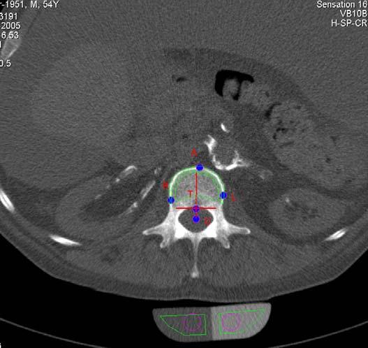 Pokud měl pacient deformující spondylózu či vystupňovanou ateromatózu břišní aorty, mohly být