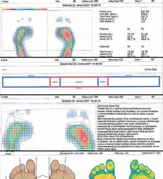 DIAGNOSTIKA DIGITÁLNÍ BAROPODOMETRICKÁ DIAGNOSTIKA Klientům, kteří se ještě