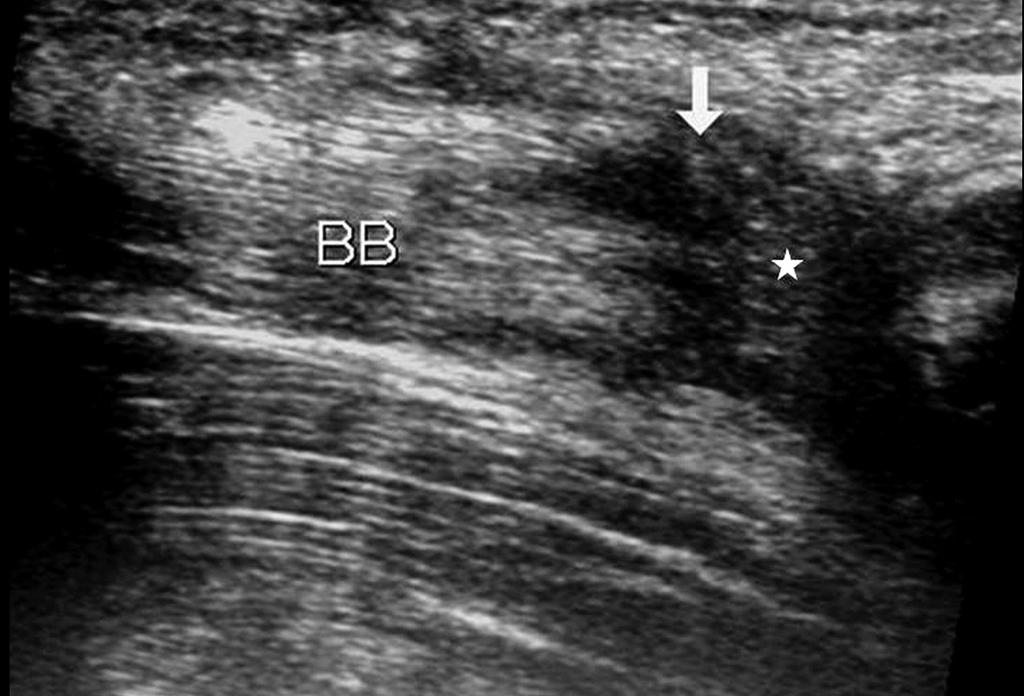 Peroperační nález; limitovaný přední přístup. Patrná je kompletní abrupce šlachy m. biceps brachii vpravo s mírně rozvlákněným a edematozním koncem. Obr. 2.